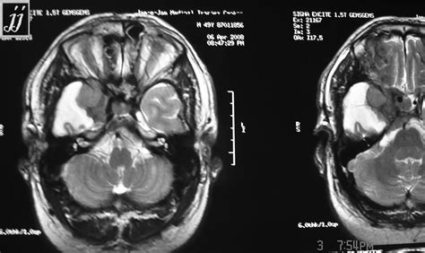 Right Supra Parasellar Meningioma Radiopaedia