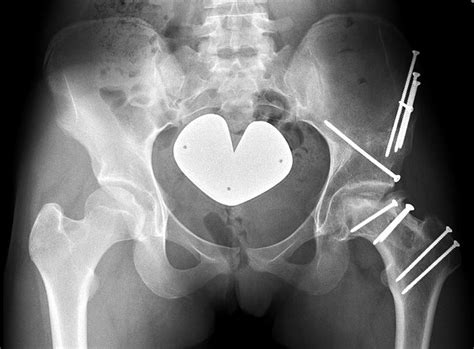 Case One Latest Follow Up Anteroposterior Pelvic Radiograph At Three