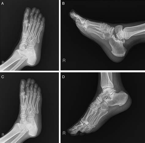 Talus Lateral Process Fracture