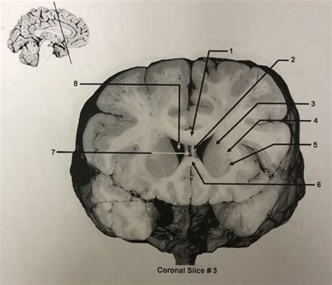 Coronal Slice 3 Flashcards Quizlet