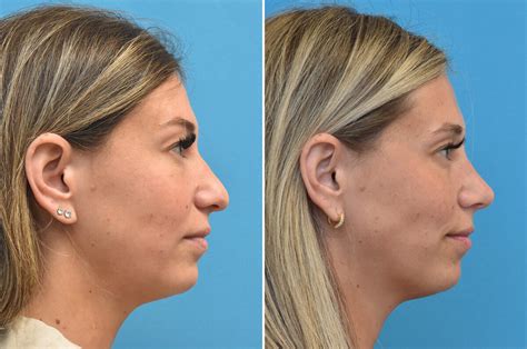 Rhinoplasty 101 Your Guide To Correcting A Crooked Nose