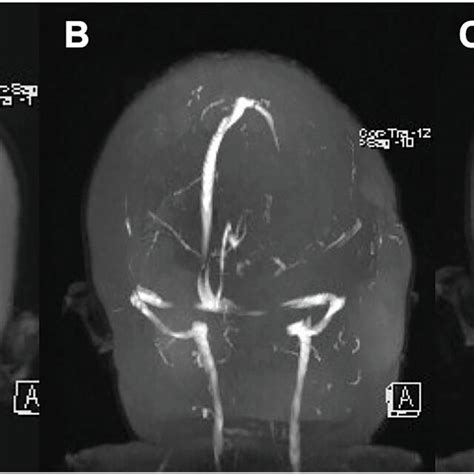 A 3d Tof Mra Demonstrating Bilateral Stenosis Of The Transverse Sinus