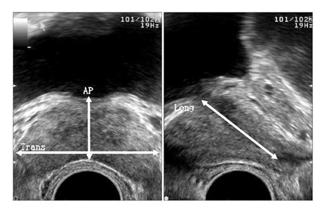 Study Of Prostate Of Korean Young Adult Using Transrectal Ultrasonography