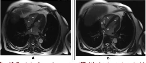 Lipomatous Hypertrophy Of The Interatrial Septum Accompanied By