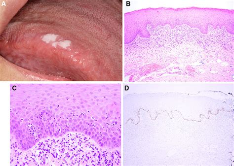 Parakeratosis Epithelial Atrophy With Mild Dysplasia And Chronic