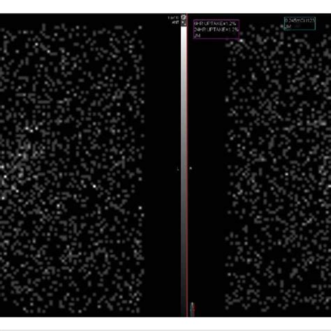 Thyroid Uptake Scan Radioactive Iodine Uptake Scan Of Thyroid