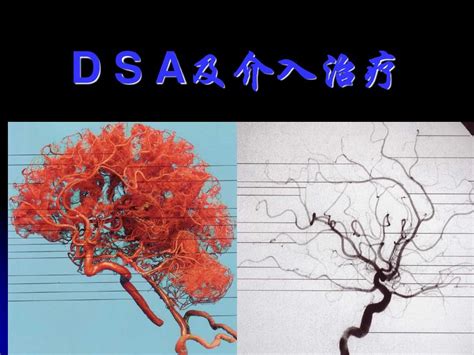 Dsa介入治疗课件word文档在线阅读与下载无忧文档