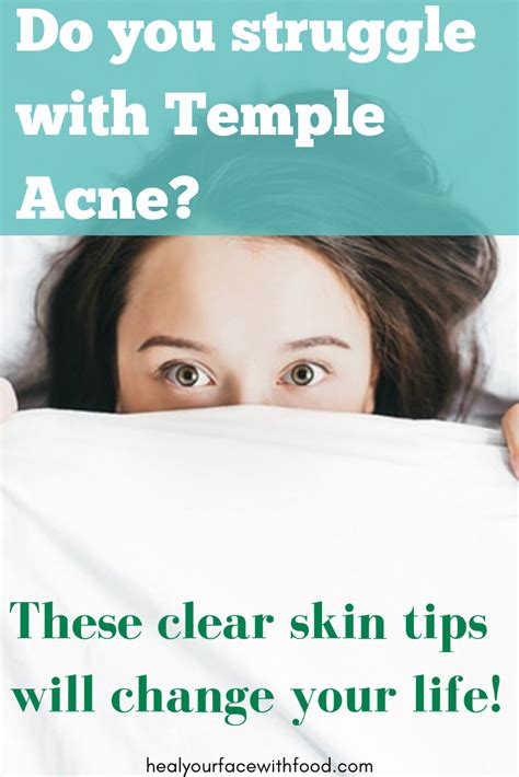 Do You Struggle With Temple Acne Read All About These Clear Skin Tips