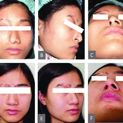 A Preoperative Frontal View Of The Patient B Preoperative Planning