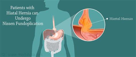 Nissen Fundoplication Indications Types And Risks