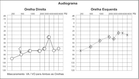 Perda Auditiva Neurossensorial Perda de Audição Neurossensorial