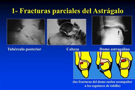 Ppt Fracturas Del Astrágalo Powerpoint Presentation Free Download