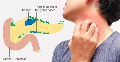 Early Signs of Pancreatic Cancer Symptoms - CancerOz