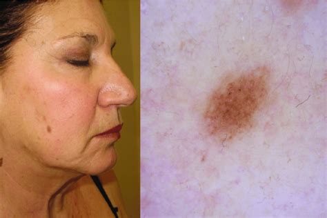 Clinical And Dermoscopic View Of A Melanoma In Situ Seen On The Cheek