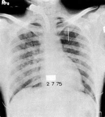 Respiratory Tract Burns After Aspiration Of Hot Coffee Chest