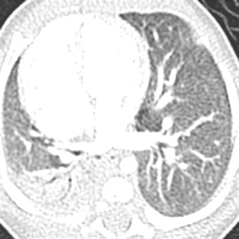 Computed Tomography Ct Scan At 1 Month Of Age It Revealed Download Scientific Diagram