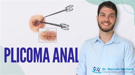 Plicoma Anal O Que é Como Tratar Youtube