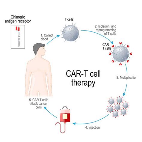 CAR T-Cell Therapy | Blood and Marrow Transplantation Program ...