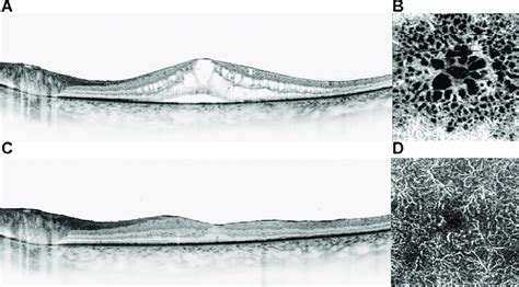 The Foveal Avascular Zone In The Deep Retinal Vessel Layer Might Be Download Scientific Diagram