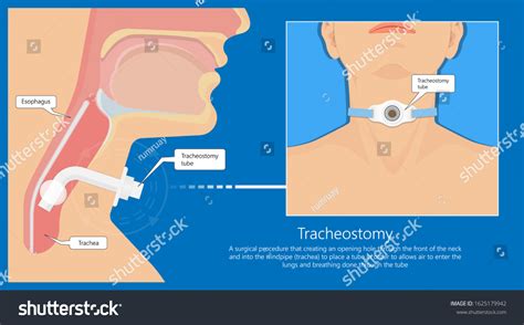 Tracheostomy Surgical Patient Treatment Procedure Medical Vetor Stock