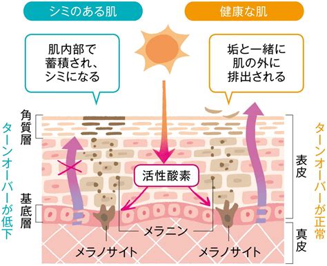 シミの種類や見分け方、原因は？／初めてのシミ取り治療＠美容クリニック①