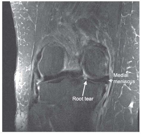 Meniscus Root Repair | Musculoskeletal Key