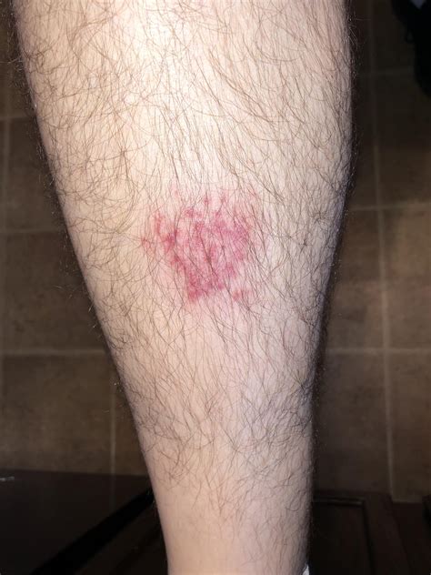 Rocky Mountain Spotted Fever Rash Dog