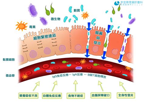 腸漏症leaky Gut Syndrome，會讓您這裡痛、那裡不舒服 李宜霖胃腸肝膽科