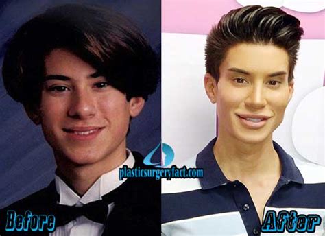 Justin Jedlica Human Ken Doll Plastic Surgery