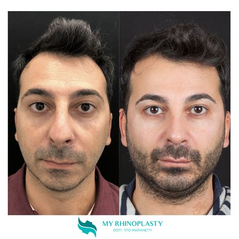 Naso A Patata La Chirurgia Per Correggerlo My Rhinoplasty