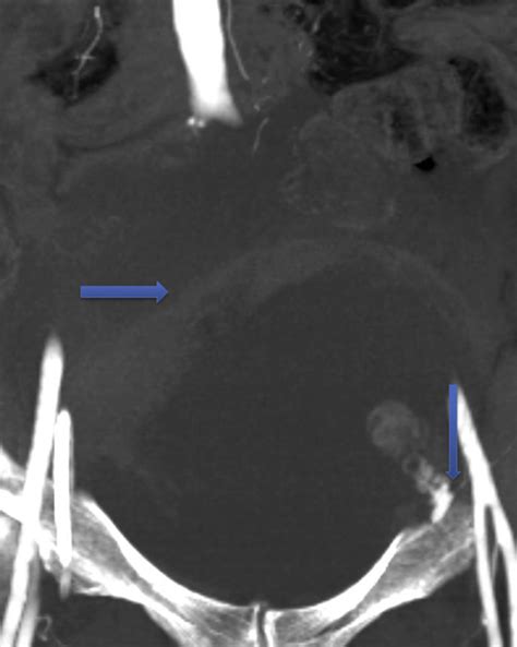 Bilateral Renal Forniceal Rupture Due To Retroperitoneal Hematoma After