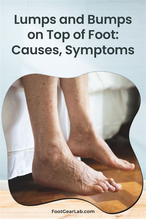 Lumps and bumps on top of foot causes symptoms and treatment – Artofit