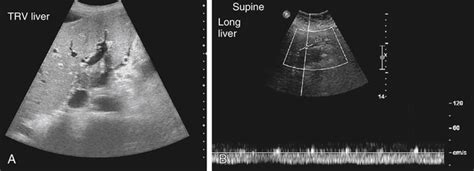 Diffuse Liver Disease | Radiology Key