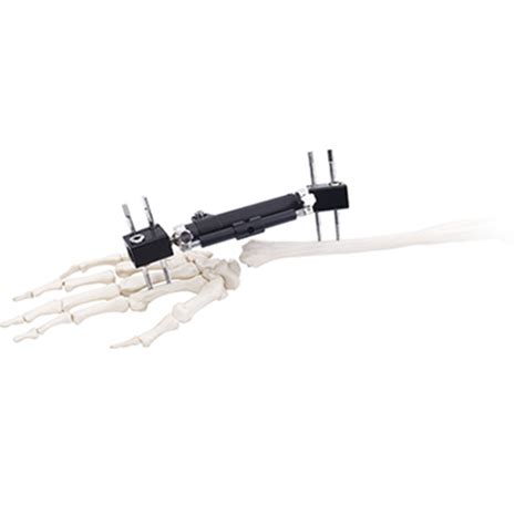 Orthofix Wrist External Fixatorsradiolucent Type For Orthopedic