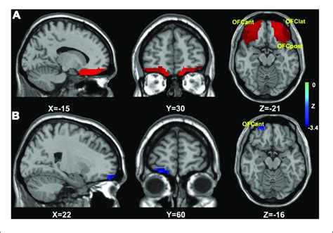 The Mask And Results Of OFC Based VBM Analysis A The OFC Analysis