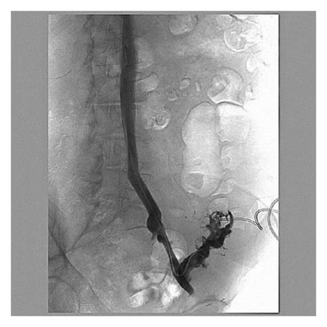 Follow Up Venogram Demonstrating Widely Patent Iliac Vein Stent And Download Scientific