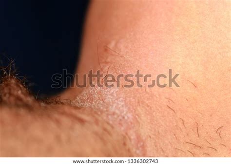 Fungal Infection Groin Psoriasis Dermatitis Eczema Foto Stok 1336302743 Shutterstock