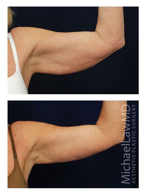 Armpit Liposuction Before And After Photos Printable Templates Free