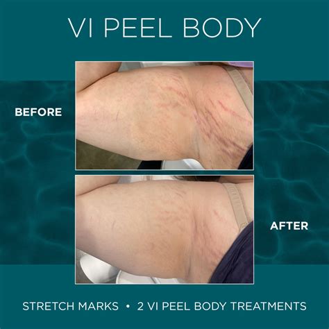 Vi Peels® Medical Laser Solutions