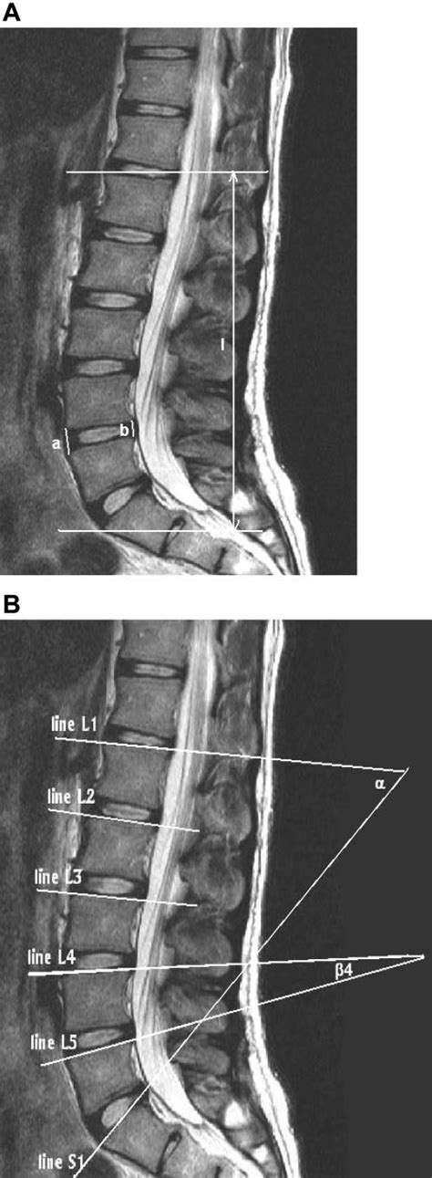 A Parameters Measured In Sagittal Magnetic Resonance Imaging Mri Of Download Scientific