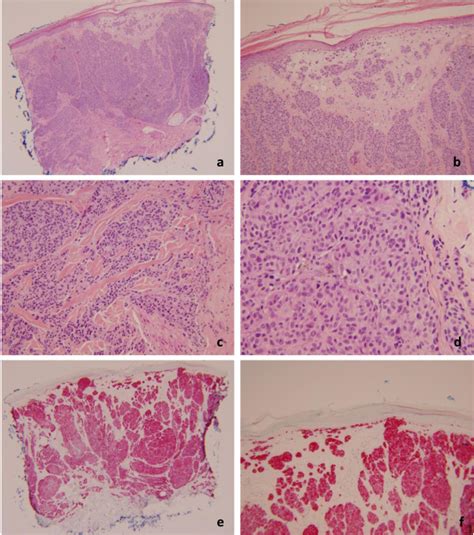 Punch Biopsy From The Scalp With Malignant Melanoma 3a And 3b