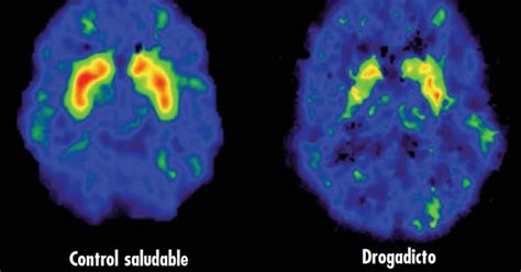 Así Impacta La Cocaína En El Cerebro De Las Personas Infobae