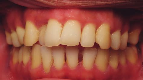 Class Ii Division 2 Malocclusion Excessive Overjet Anterior Open Bite Missing Teeth Case