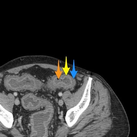 Pseudomembranous Colitis Image Radiopaedia Org