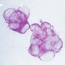 Stimulation Of Antitumor Ctl Cells By Autologous Ovca Fc A Pbmc Were