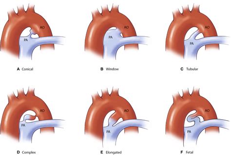 Patent Ductus Arteriosus A Contemporary Perspective For The Pediatric