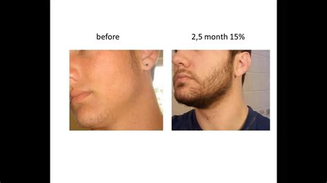 Stimulate Beard Growth With Minoxidil Before And After Youtube