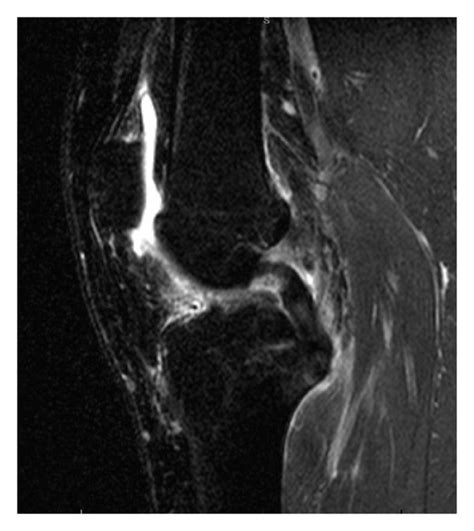 T Weighted Fat Suppressed Sagittal Plane Mri Images For Evaluation Of