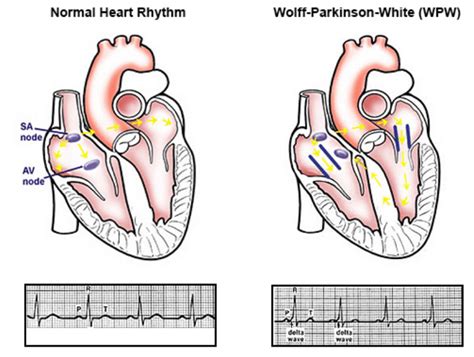 Wolff Parkinson White Syndrome Hope For Hearts