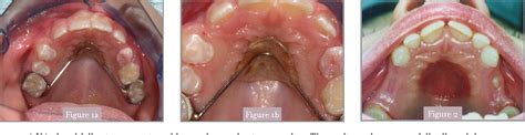 PDF The Transpalatal Arch An Alternative To The Nance Appliance For